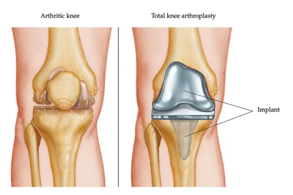 Total Knee Replacement